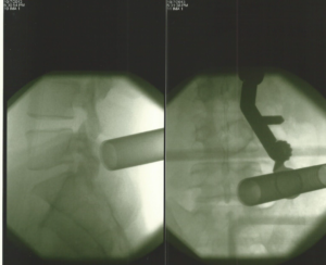 Minimally invasive surgery uses small metal tubes for the prolapsed disc treatment.